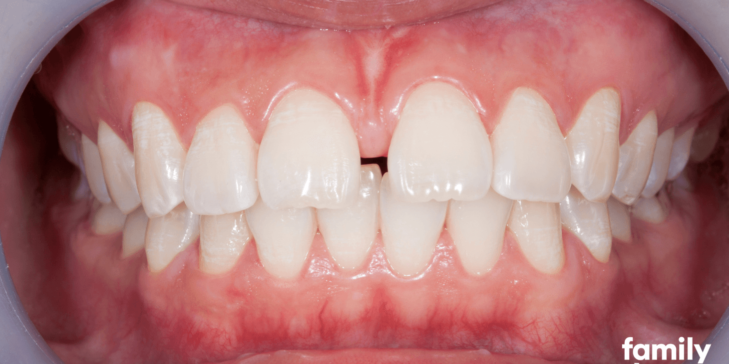 Carillas para Espacios entre Dientes