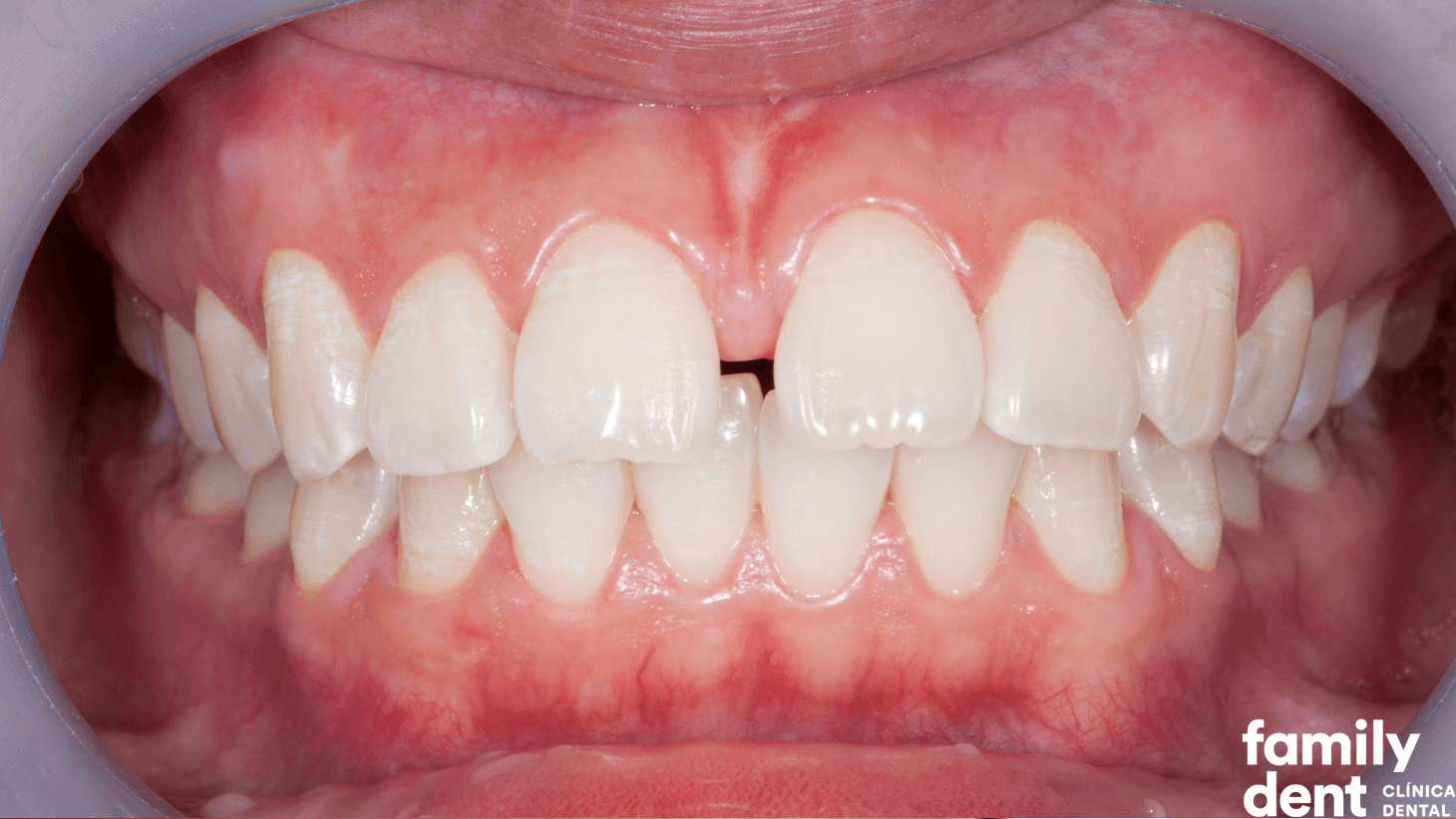 FAMILY – Carillas para Espacios entre Dientes Carillas para Espacios entre Dientes